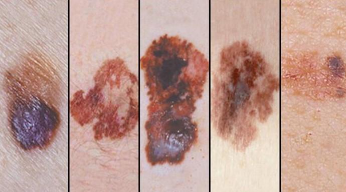 melanoma3