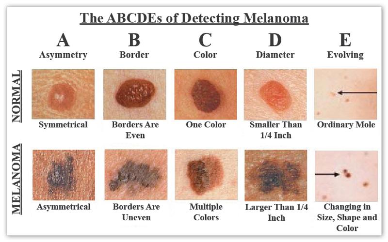 melanoma4
