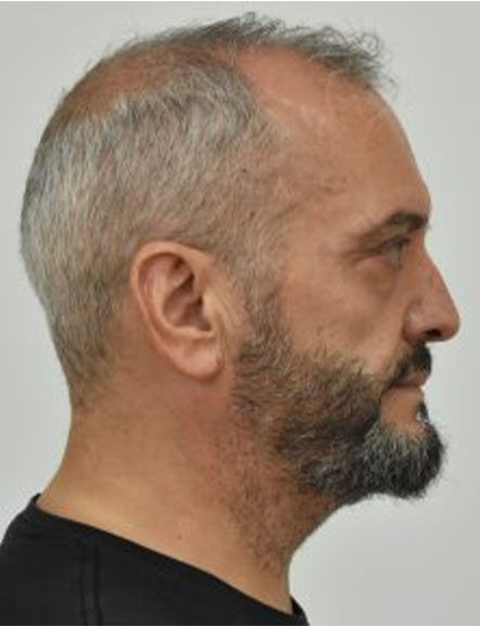 viastes 12xroni kolonos astun 3
