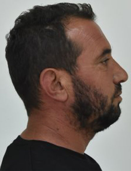 viastes 12xroni kolonos astun 6
