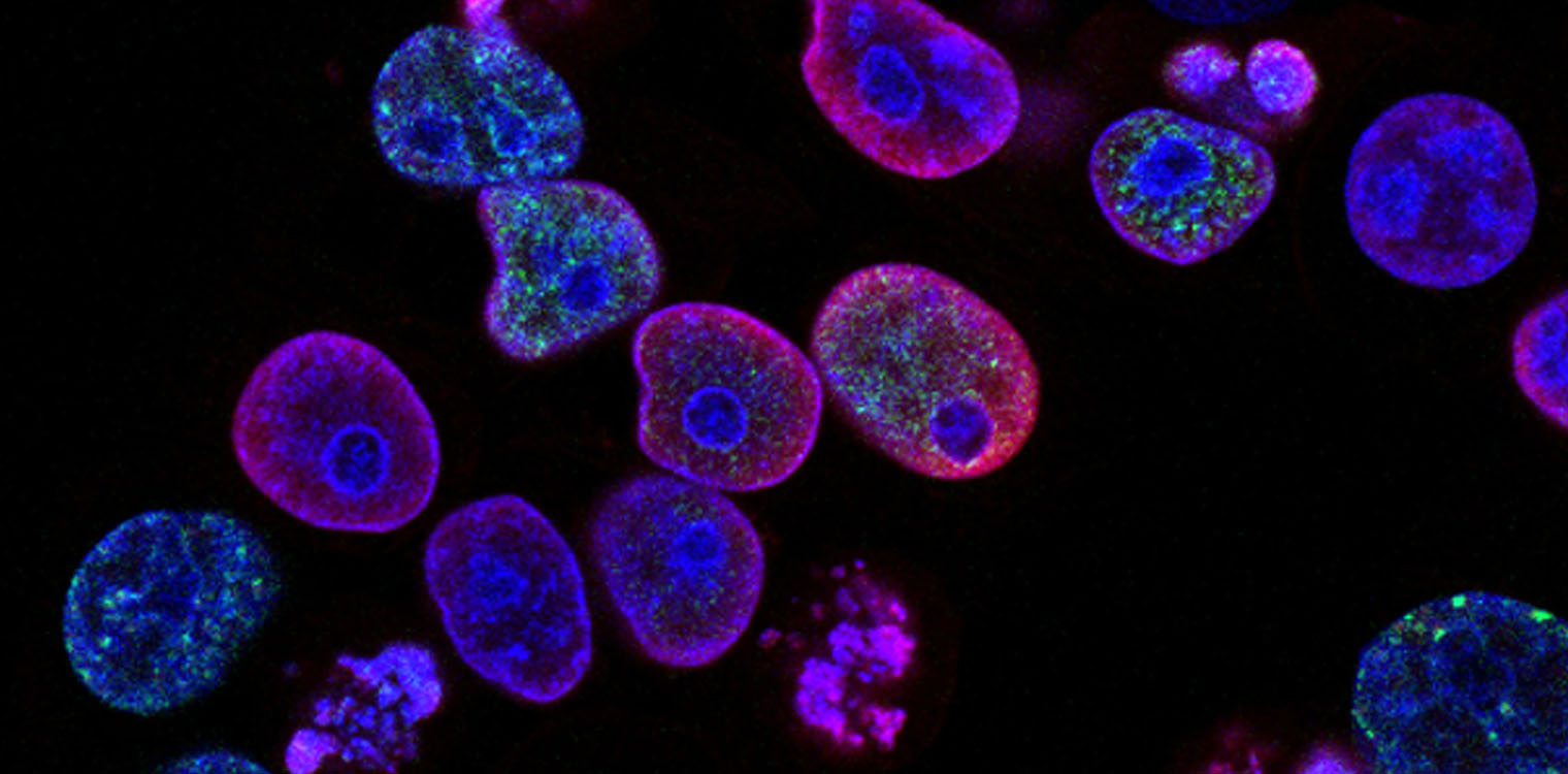 Σημαντική επιστημονική ανακάλυψη για τον καρκίνο του προστάτη: Μεταλλάξεις σε 11 γονίδια εντόπισαν οι ερευνητές – Πώς αυτό θα μπορούσε να μειώσει τον κίνδυνο