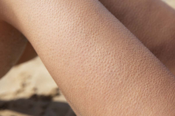 Γιατί ανατριχιάζουμε ξαφνικά χωρίς να κρυώνουμε;