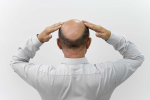 Οι χώρες με τα υψηλότερα ποσοστά φαλάκρας στους άνδρες – Η θέση της Ελλάδας