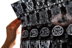 Πόσο αυξάνουν τον κίνδυνο άνοιας τα χτυπήματα στο κεφάλι – Μελέτη απαντά