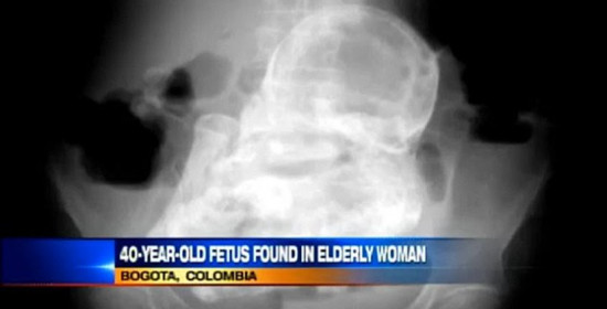Κολομβία: Γυναίκα 84 ετών ήταν έγκυος για 40 χρόνια!