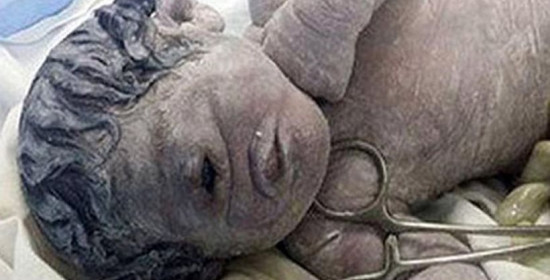 Συγκλονισμένη η ιατρική κοινότητα από τη γέννηση του μωρού-κύκλωπα στην Αίγυπτο
