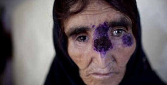Σαρκοβόρο βακτήριο εξαπλώνεται στην Συριά και το Ιράκ - Τρώει το δέρμα των θυμάτων του